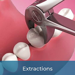 safe, expert, and painless tooth extraction services.